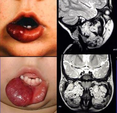 Lower lip hemangioma with intraoral extension. 