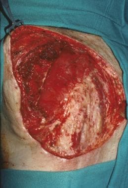 Defect following wide excision of squamous cell ca