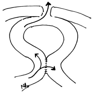 Bypass of a densely adherent fistula by anastomosi