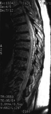 Spinal malformation. This is a sagittal T2-weighte