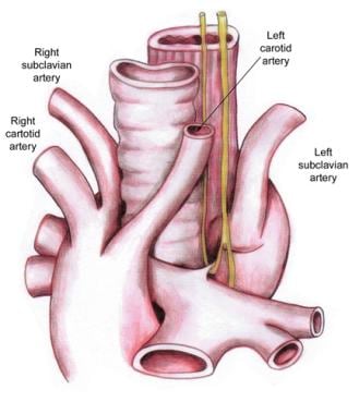 Right aortic arch with aberrant left subclavian ar