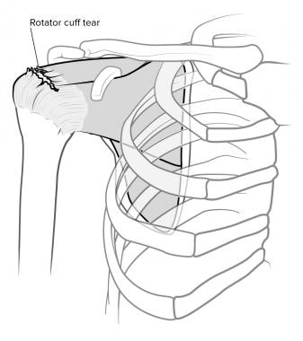 Rotator cuff tear, anterior view. 