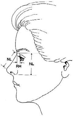 Nasal length (NL) represents the distance from the