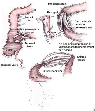 Diagram illustrating anatomy of intussusception. 