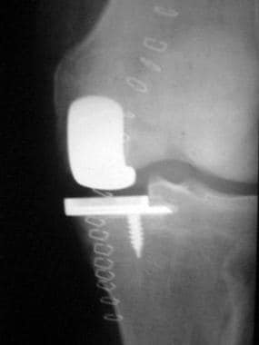 Complications of total knee arthroplasty. With uni