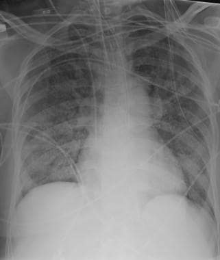 Chest radiograph in a patient with thyroid cancer 