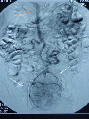 Gastrointestinal stromal tumor. Delayed images dem
