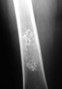 Enchondroma. Frontal radiograph of the right thigh