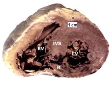 Postinfarction ventricular septal rupture. Heart s