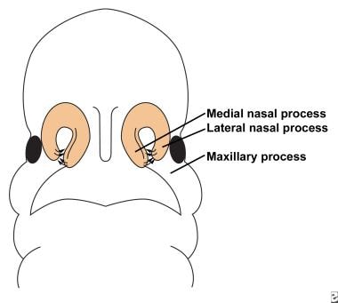 Illustration depicts fusion of the lateral nasal, 