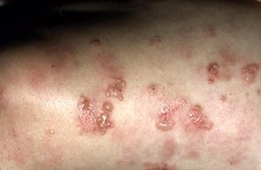 Classic vesicles of dermatitis herpetiformis. 