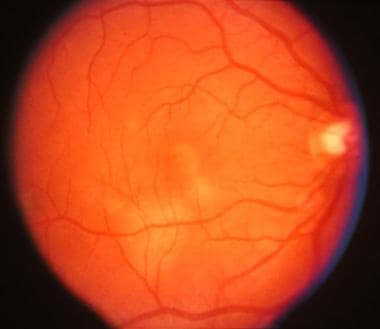 Posterior pole of right eye. Early acute posterior