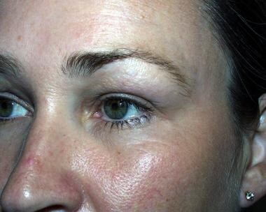 Postoperative view after anchor blepharoplasty of