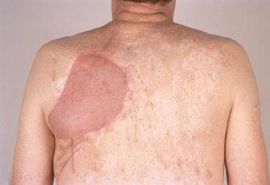 Reconstruction with ipsilateral latissimus dorsi m