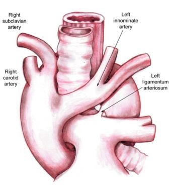 Right aortic arch with mirror-image branching and 