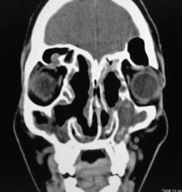 Coronal CT scan showing the postoperative view fol