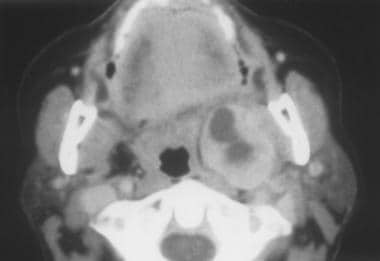 CT scan of prestyloid space mass. The lesion cause