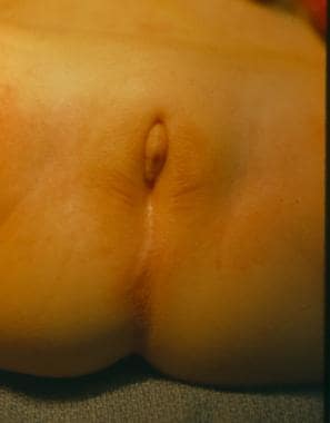 Perineum of a newborn with persistent cloaca. Note