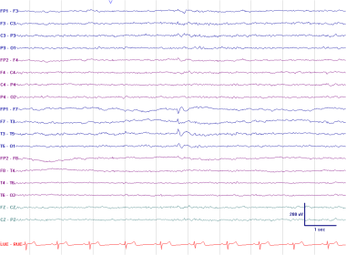 Left anterior temporal spike. This EEG was recorde
