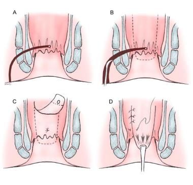 post anal fistulotomy Deep