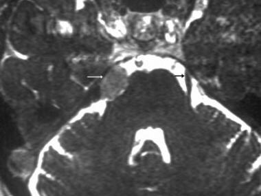 Trigeminal schwannoma. Axial constructive interfer