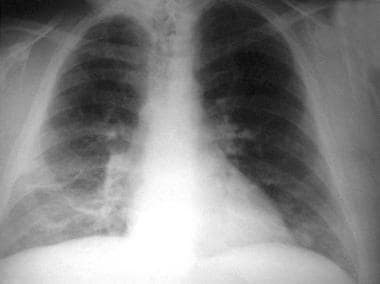 Constrictive pericarditis. A man presented with an