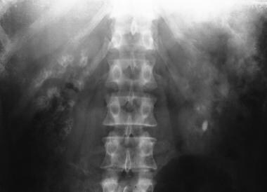 Radiograph depicting kidneys with bilateral pyrami