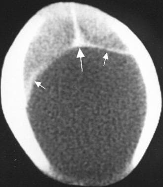 Dandy-Walker malformation. An axial CT scan showin