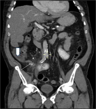 ct abdomen contrast scan abdominal pelvis tomography computed scanning thorax oral coronal iv background