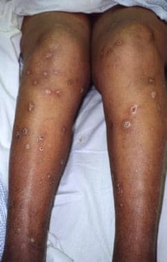 Typical ecthyma lesions of the lower extremities. 