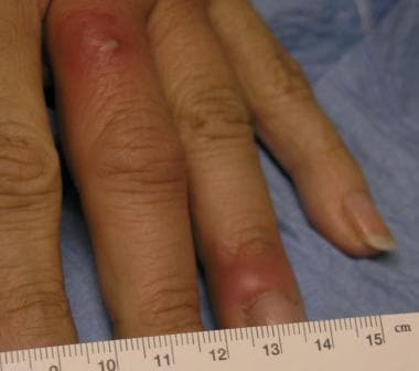 Paronychial erythema and edema with associated pus