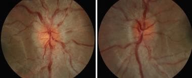 Optic disc swelling in the right eye and left eye 