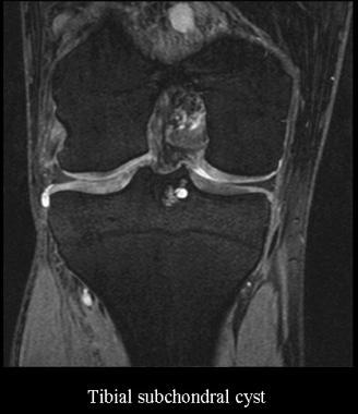 Tibial subchondral cyst. Courtesy of James K. DeOr