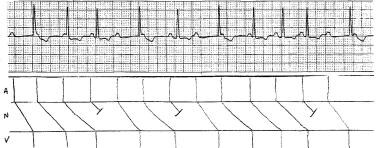 Second-Degree Atrioventricular Block. Variable-rat