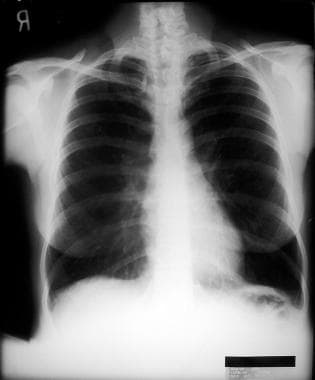 Emphysema. An emphysematous lung shows an increase
