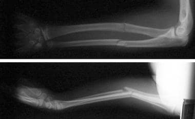 Fractures of the radius and ulna with dorsal angul