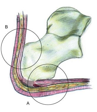 The hindfoot is composed of the talus and the calc