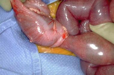 Intraoperative appearance of ileocolic intussuscep