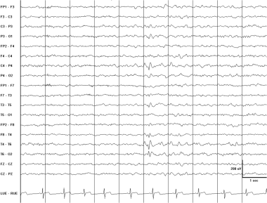 Right posterior temporal spike. This EEG is from a