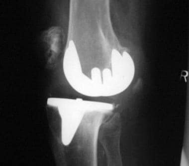 Complications of total knee arthroplasty. Dislocat