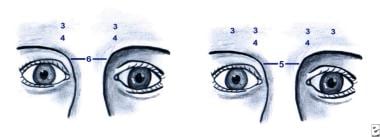 (1) Botulinum toxin dose used to treat glabellar f