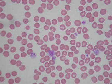 Peripheral smear from a patient with Bernard-Souli