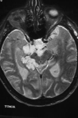 T2-weighted axial image demonstrating a hyperinten