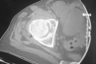 Axial computed tomography scan in a patient with a