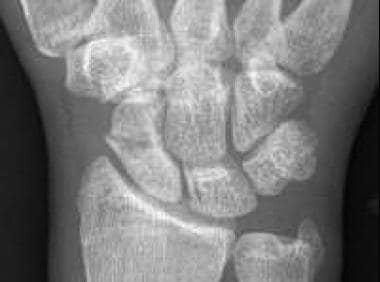 Scaphoid waist fracture with some resorption, as s