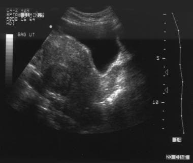 Transabdominal sagittal sonogram shows a heterogen