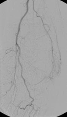 Digital subtraction angiogram shows a small arteri