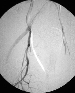 Right iliac artery angiogram (early phase) followi