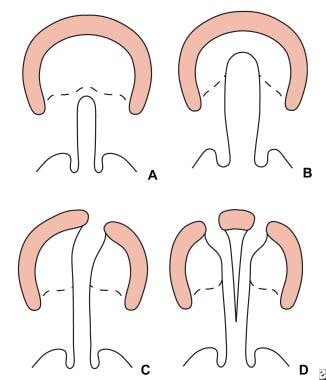 Veau classification of cleft lip and palate. A: Gr