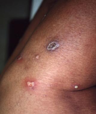 The stages of ecthyma: the lesion begins as a pust